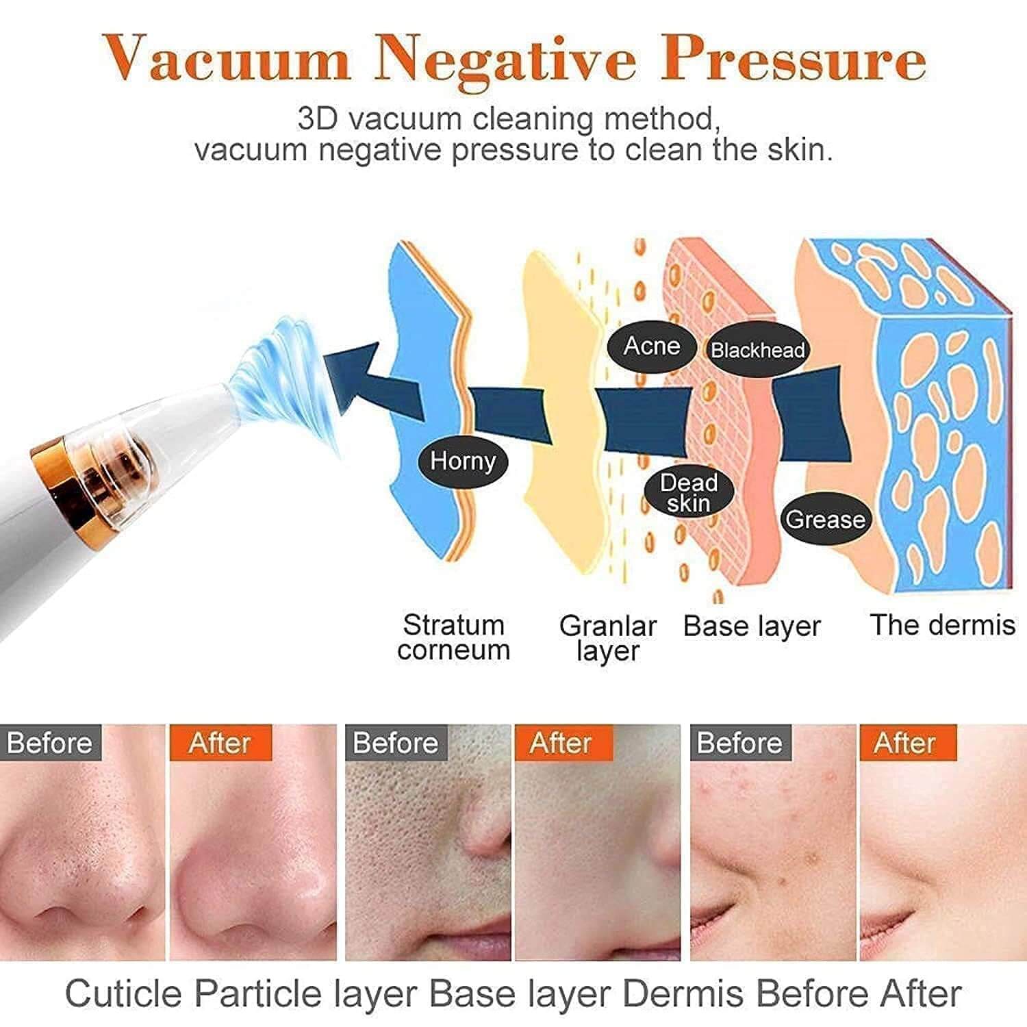 Pore Vacuum Cleaner & Blackhead Remover